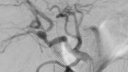 Hepatic artery pseudoaneurysm coils and onyx